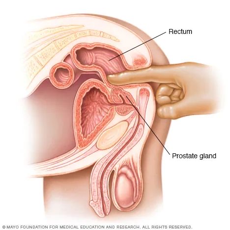 Medical diagram of a digital rectal examination, labelling the rectum and prostate gland